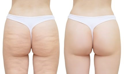 156cellulite-on-buttocks-thighs-white-260nw-1215893404.jpg